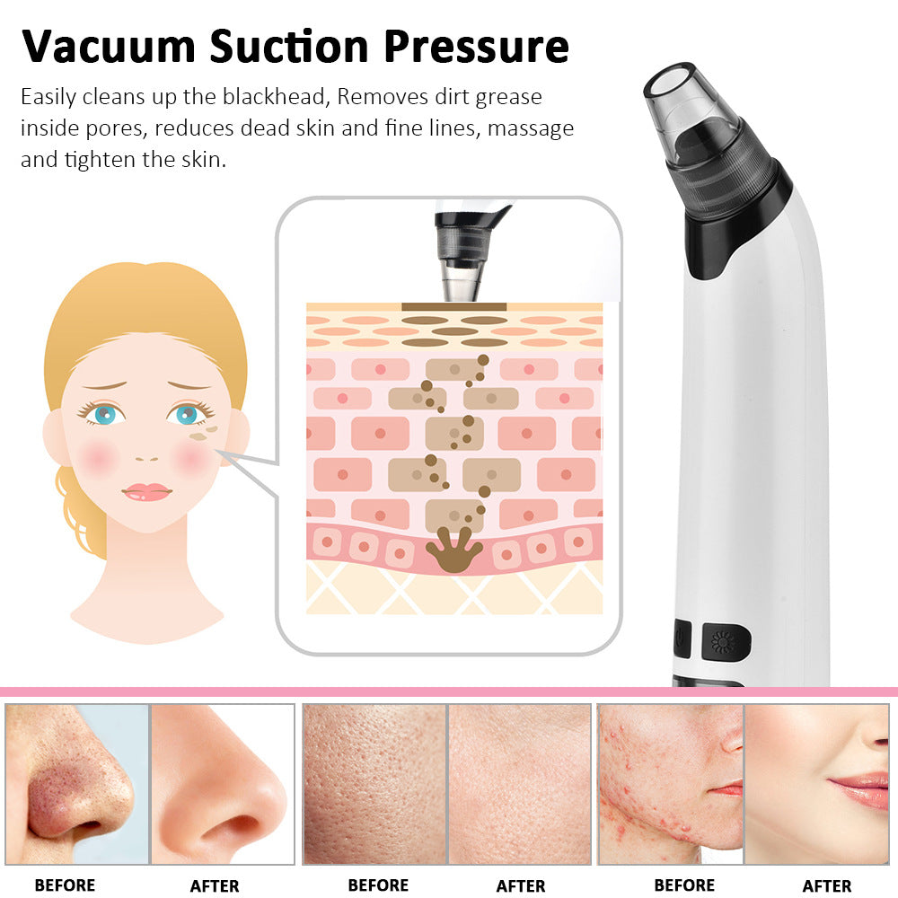 Heated Blackhead Remover